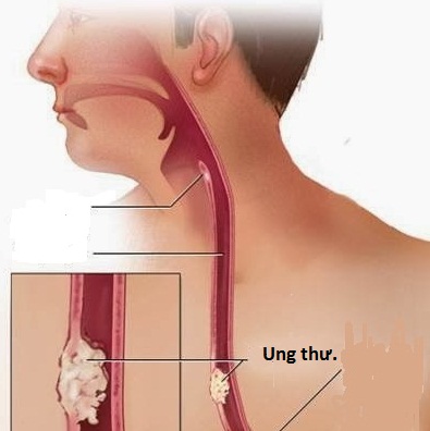 Lưu Ý Khi Cảm Thấy Nghẹn Cổ Họng