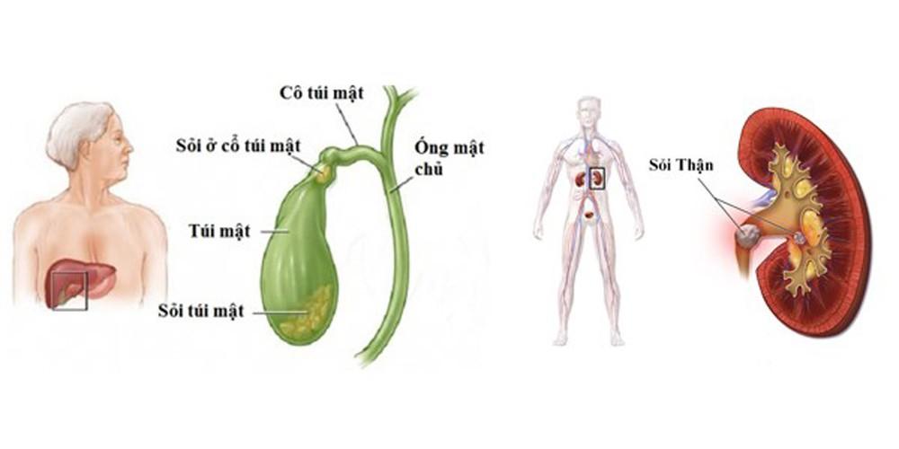 4. Phương pháp chẩn đoán sỏi mật và sỏi thận